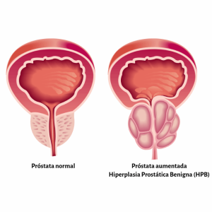 Próstata Aumentada, Hiperplasia Prostática Benigna